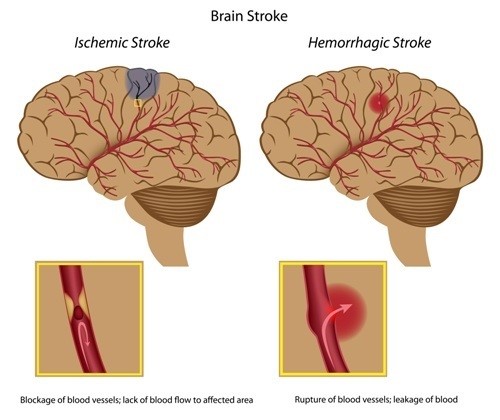 brain stroke