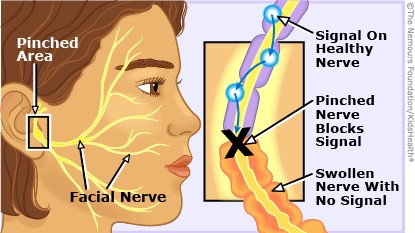 Facial Stroke