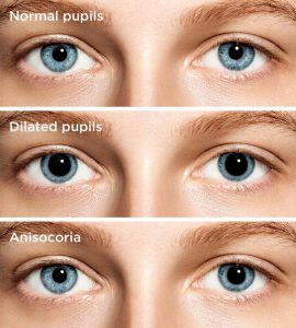 hypovolemic shock